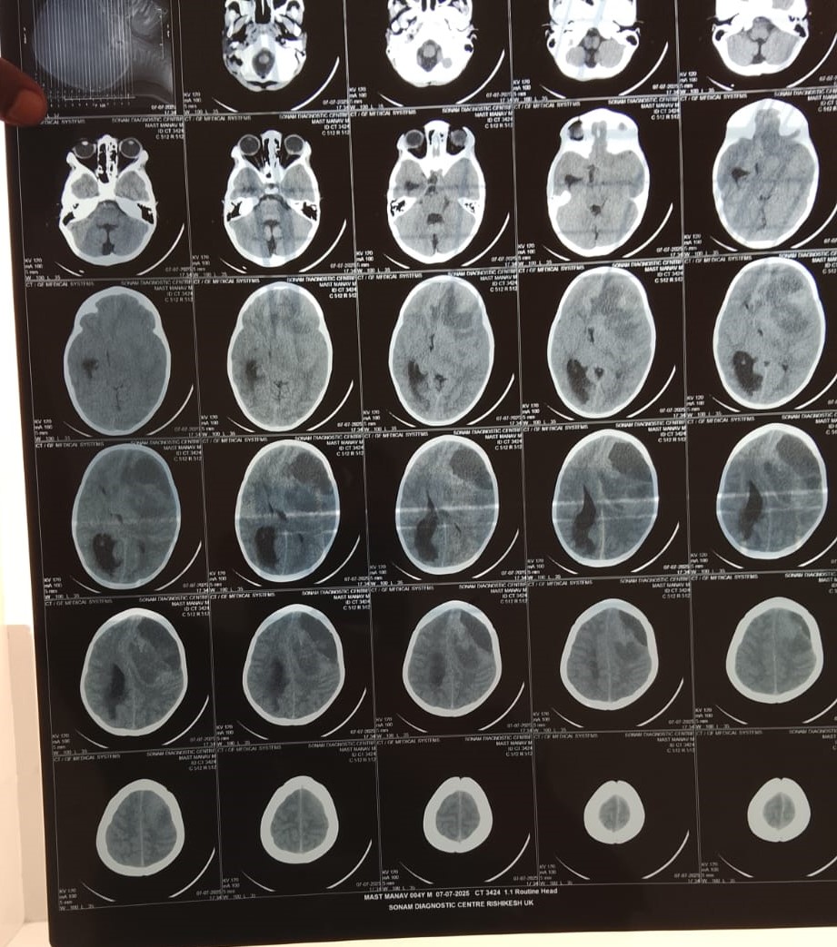 Save 4-Year-Old Manav's Life – Urgent Brain Surgery Needed