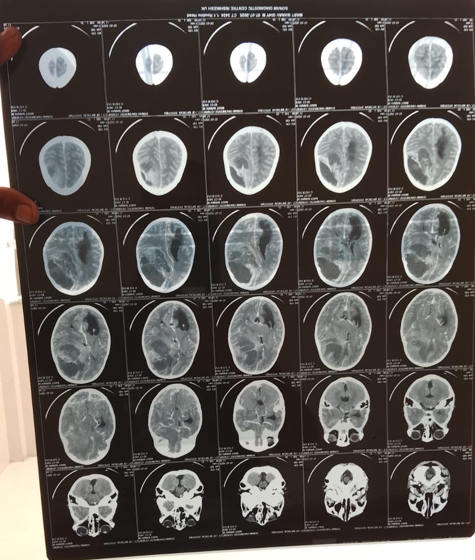 Save 4-Year-Old Manav's Life – Urgent Brain Surgery Needed